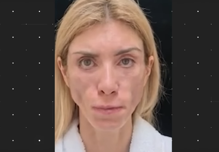 Хирурги, изуродовавшие лицо модели из Сочи, заплатят пострадавшей 1 миллион рублей