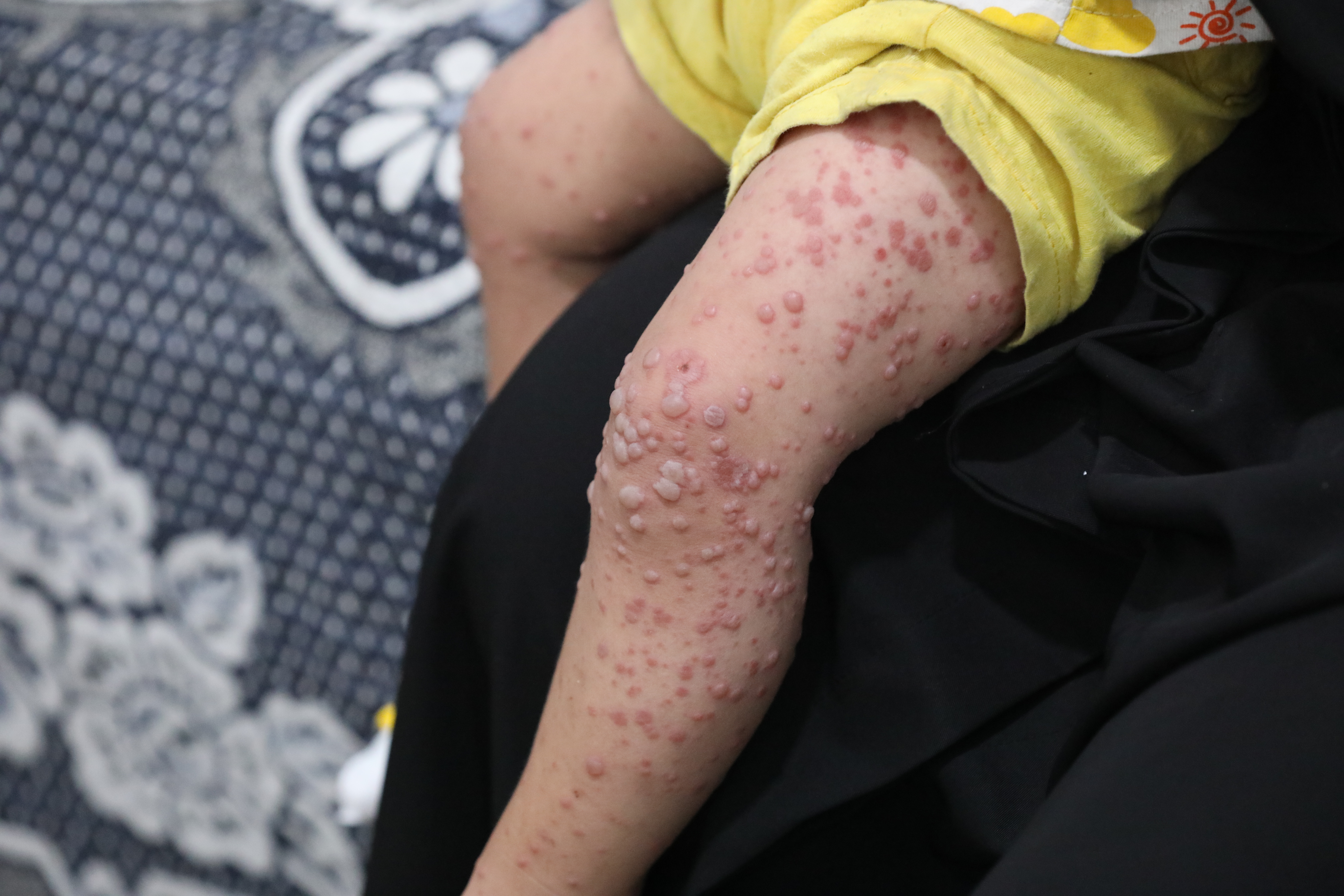 заболевание