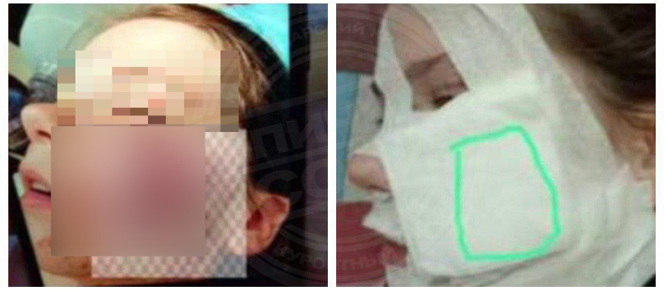 Ротвейлер откусил часть лица 10-летней девочке в Сочи