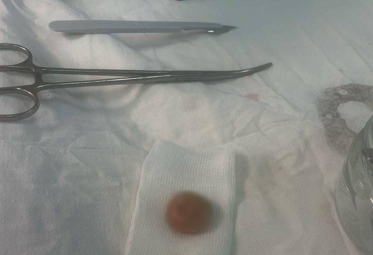 Камень размером с орех медики обнаружили в мочевом пузыре двухлетней девочки