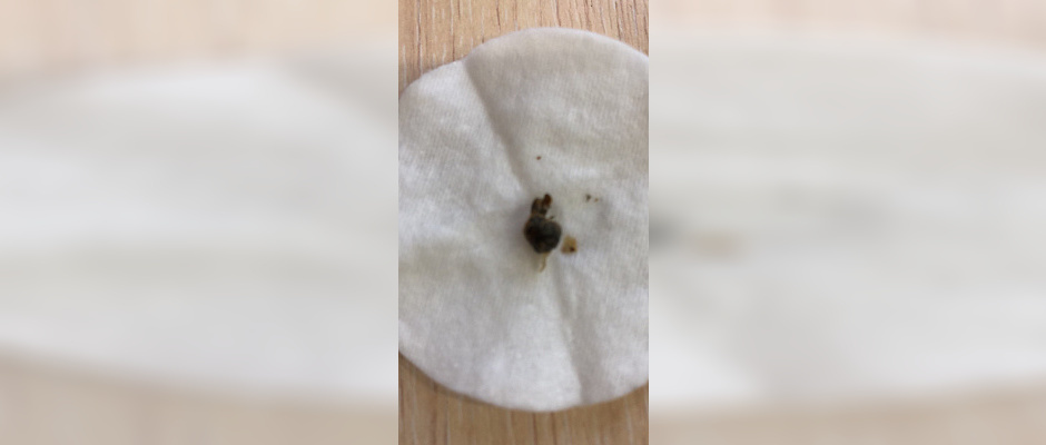 В Армавире в ухе 11-летнего мальчика проросло семя дерева