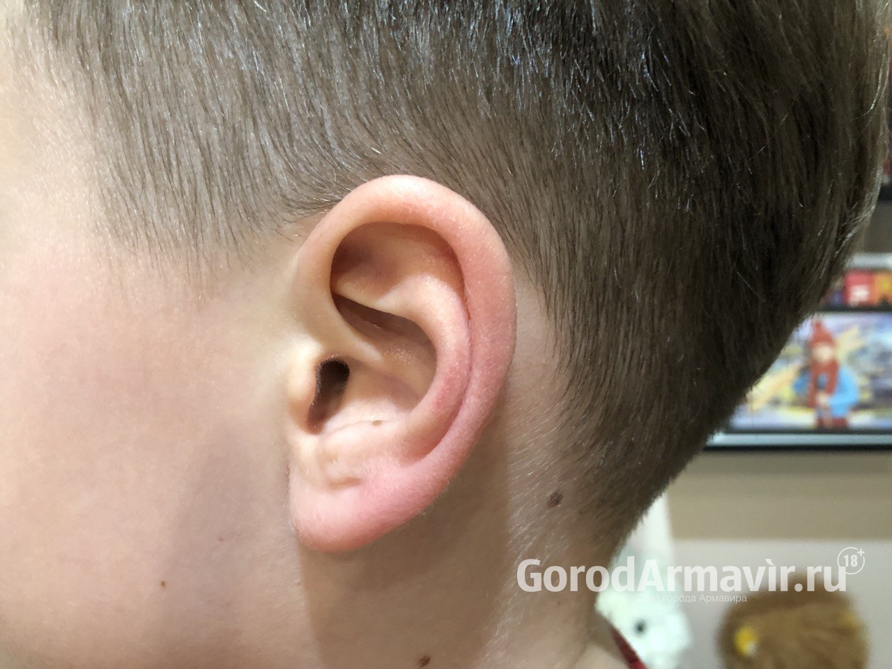 В Армавире в ухе 11-летнего мальчика проросло семя дерева