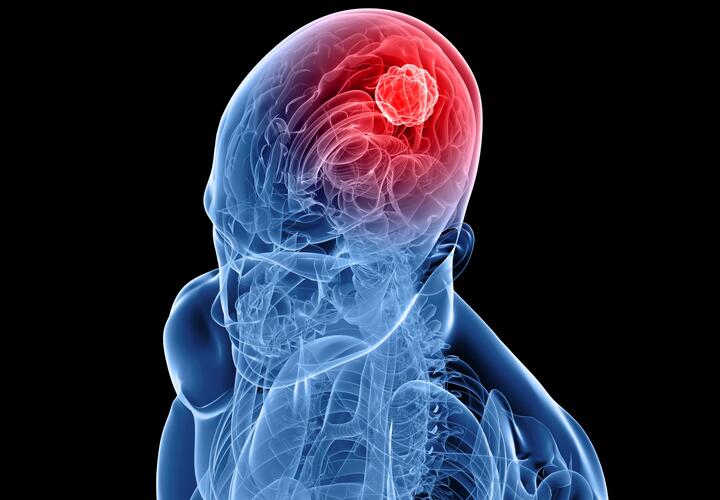 Онколог назвал самый распространенный симптом рака головного мозга