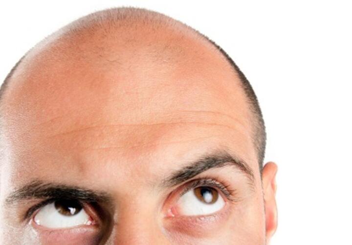 По волосам не плачут: средство от облысения повышало риск суицида
