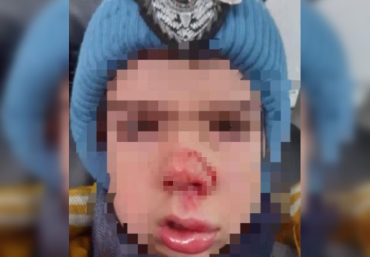 В Тимашевске 7-летний ребенок получил травмы, упав в ливневку
