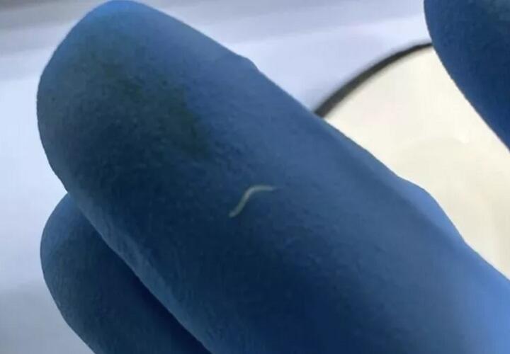 В Новороссийске врачи нашли у пациента клубок паразитов в кишечнике