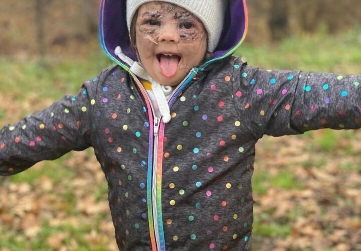 Из-за «ошибок лечения» девочку с «маской Бэтмэна» больше не привезут в Краснодар