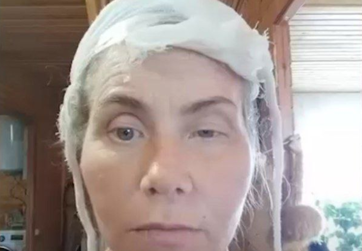 У женщины после операции опустился глаз 