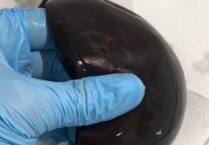 В желудке женщины в Новороссийске врачи обнаружили «мячик» 