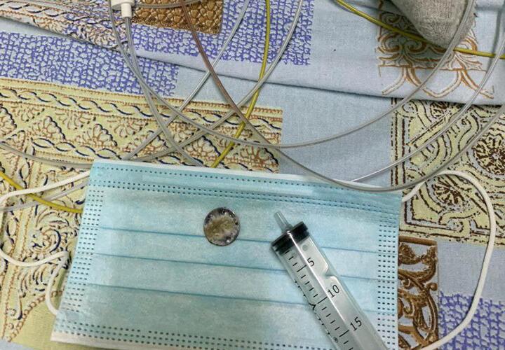 Двое маленьких детей в Туапсе проглотили батарейки