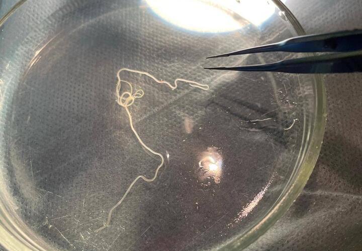 В Уфе врачи из глаза женщины вытащили червя