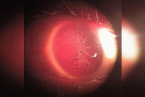 В Новороссийске хирурги-офтальмологи спасли пациенту глаз