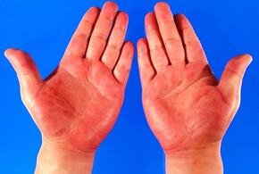 Красные руки могут быть симптомом смертельной болезни