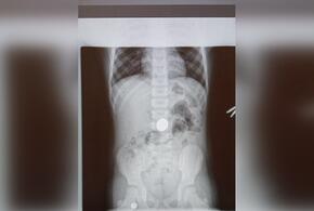 Медики Туапсе извлекли пятирублевую монету из желудка ребенка