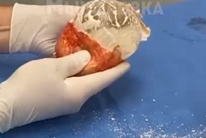 Женщины рискуют, но все равно ставят себе в грудь протезы