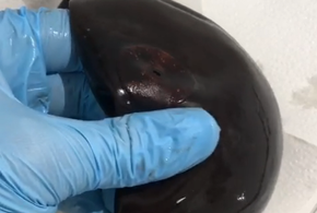 В желудке женщины в Новороссийске врачи обнаружили «мячик» 